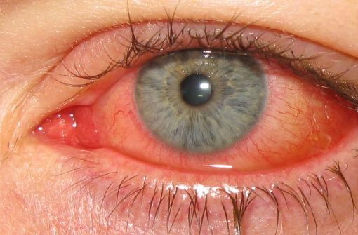 Die Augengrippe (medizinisch: Adenovirus-Konjunktivitis)  ist eine Viruserkrankung der Binde- und Hornhaut des Auges. Foto: Marco Mayer - Wikimedia Commons
