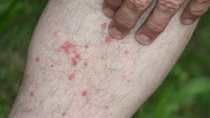 Als rote Pünktchen zeigen sich die Bisse der Grasmilbe. Bis zu zwei Wochen lang verursachen sie starken Juckreiz. Foto: StN