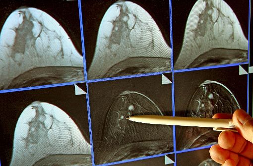 Ein Arzt zeigt auf   einen winzigen Tumor auf einer Magnetresonanz-Mammografie. In seltenen Fällen können sich solche Tumore von alleine zurückbilden. Foto: dpa