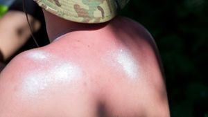 Sonnenbrand: Viele nehmen die Verbrennungen auf die leichte Schulter und schützen sich nicht ausreichend. Foto: dpa