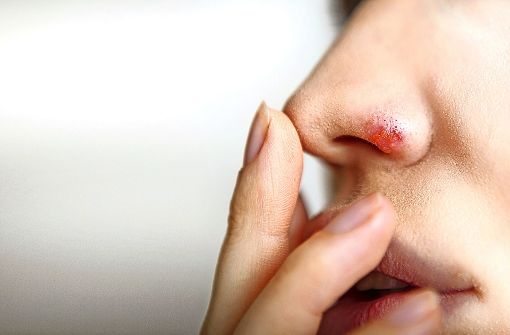 An der Nase, am Kinn, an den Händen oder an den Füßen: Herpes simplex kann im Prinzip überall am Körper vorkommen. Foto: kalcutta / Adobe Stock