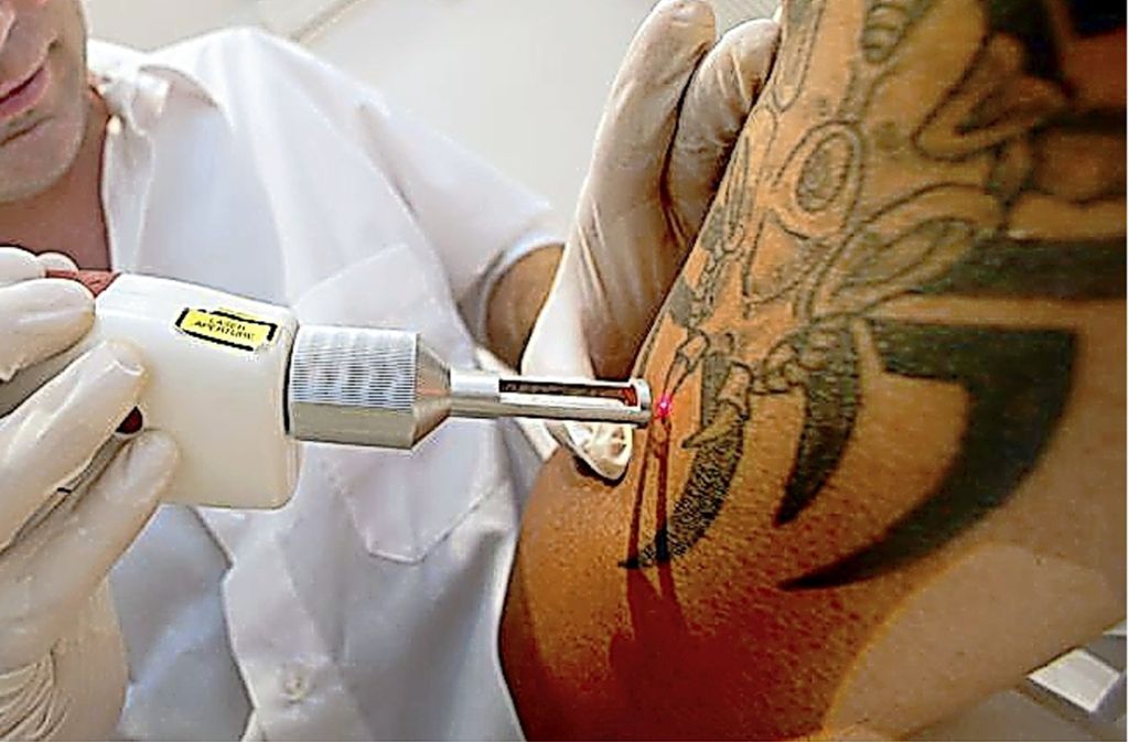 Lasern Und Die Risiken Geht Der Trend Zur Tattoo Entfernung Wissen Stuttgarter Nachrichten