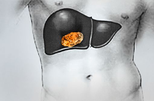 Gallensteine entstehen in der Gallenblase, die sich direkt neben der Leber befindet. Foto: eleonimages - stock.adobe.com