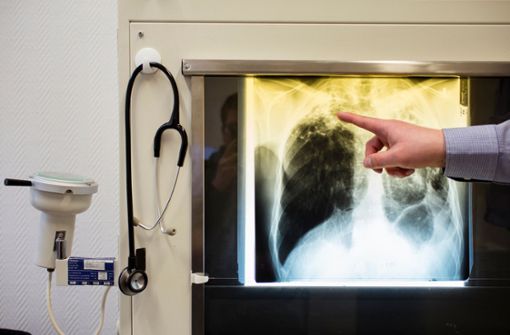 Ein Arzt zeigt am  einen Tuberkulose-Fall anhand eines Röntgenbildes. Foto: dpa