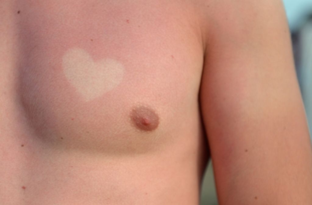Als Liebesbeweis sind Sonnenbrand-Tattoos eine sehr ungesunde Idee.