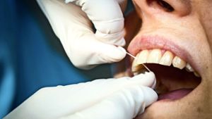 Warum die professionelle Zahnreinigung umstritten ist