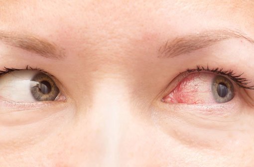 Rote Und Tranende Augen Augengrippe Was Ist Das Eigentlich