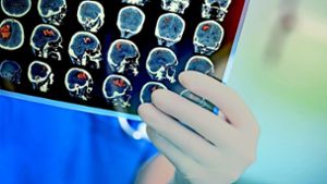 Mithilfe von Hirn-Scans  versuchen Ärzte herauszufinden, wo nach einem Schlaganfall der Blutfluss im Gehirn stockt. Lesen Sie in unserer Bilderstrecke, wie man sich vor einem Schlaganfall schützen kann. Foto: AdobeStock/sudok1