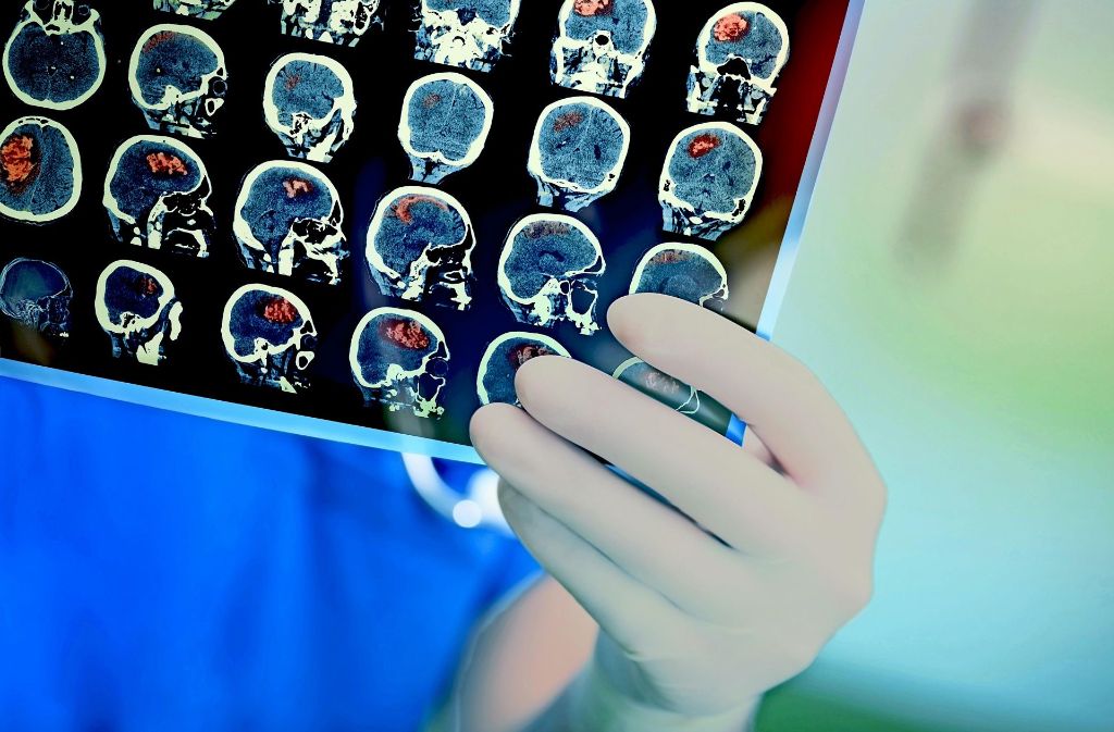 Mithilfe von Hirn-Scans  versuchen Ärzte herauszufinden, wo nach einem Schlaganfall der Blutfluss im Gehirn stockt. Lesen Sie in unserer Bilderstrecke, wie man sich vor einem Schlaganfall schützen kann.
