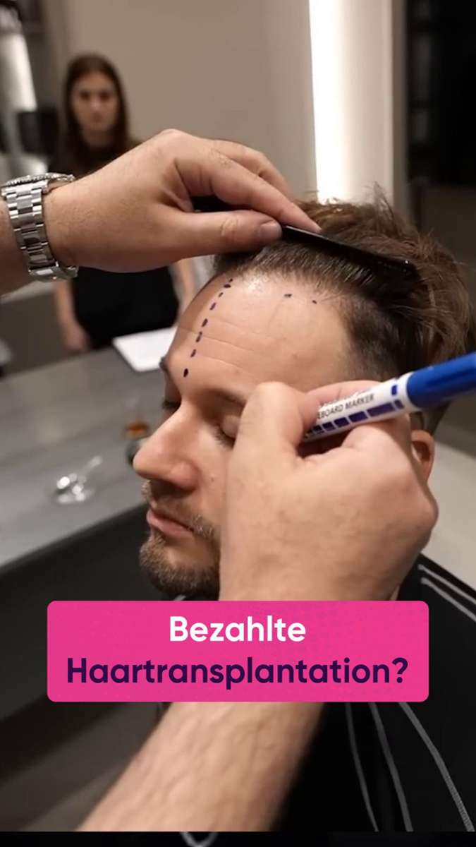 Wieso lassen sich viele Streamer Haare transplantieren?