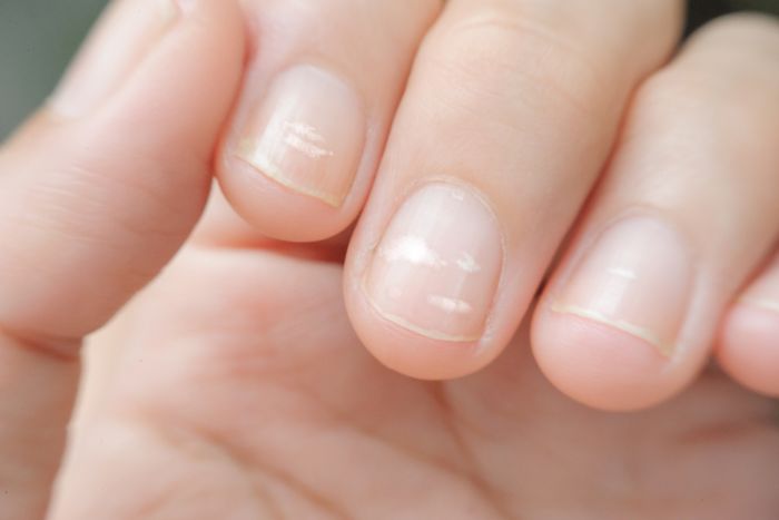 Weiße Flecken auf den Fingernägeln: Was ist die Ursache?