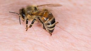 Bienenstachel entfernen