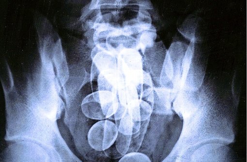 So ähnlich dürfte  sich auch die Röntgenaufnahme vom Magen- und Darmtrakt des Angeklagten dargestellt haben. Foto: dpa/Archiv