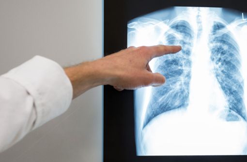 Eine Übertragung der durch Bakterien ausgelösten Krankheit Tuberkulose findet nach Angaben des Robert Koch-Instituts (RKI) über Tröpfchen in der Luft statt (Symbolbild). Foto: dpa