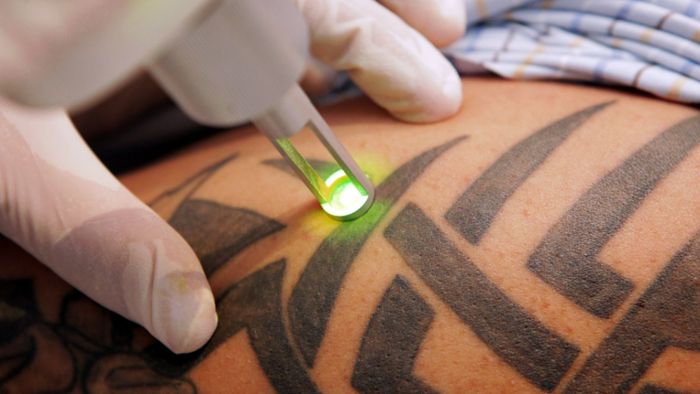 Tattoo-Entfernung per Laser künftig nur noch beim Arzt