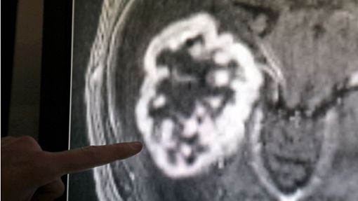 In der Diagnostik der Radiologie der Universitätsmedizin Rostock wird mithilfe der Magnetresonanztomografie ein Tumor festgestellt. Foto: dpa/Bernd Wüstneck
