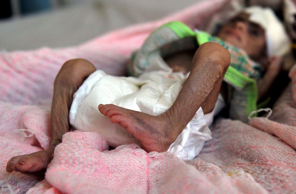 Im Jemen sind hunderttausende Kinder akut in Lebensgefahr. Foto: dpa