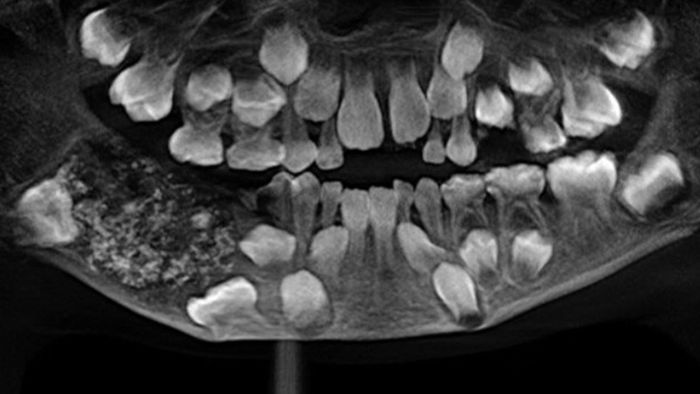 526 Zähne im Mund eines Siebenjährigen gefunden