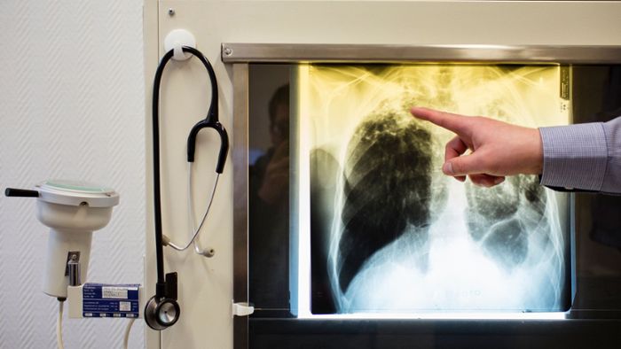 Welche Gefahr von Tuberkulose ausgeht