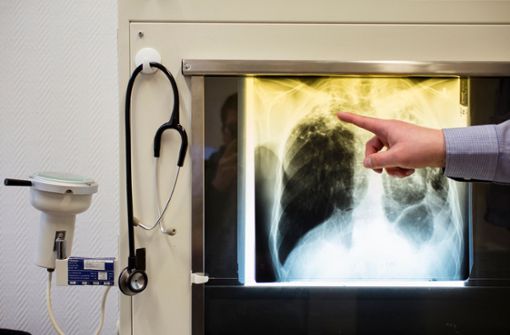 Tuberkulose-Erreger setzen sich in der Lunge fest. Dort schließen Abwehrzellen die Entzündungsherde, es bilden sich kleine Knötchen. Foto: dpa
