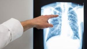 Tuberkulose-Fallzahlen in Deutschland leicht gestiegen