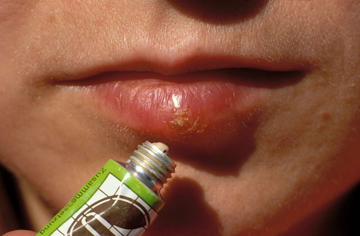 Was bedeutet Herpes an der Lippe?